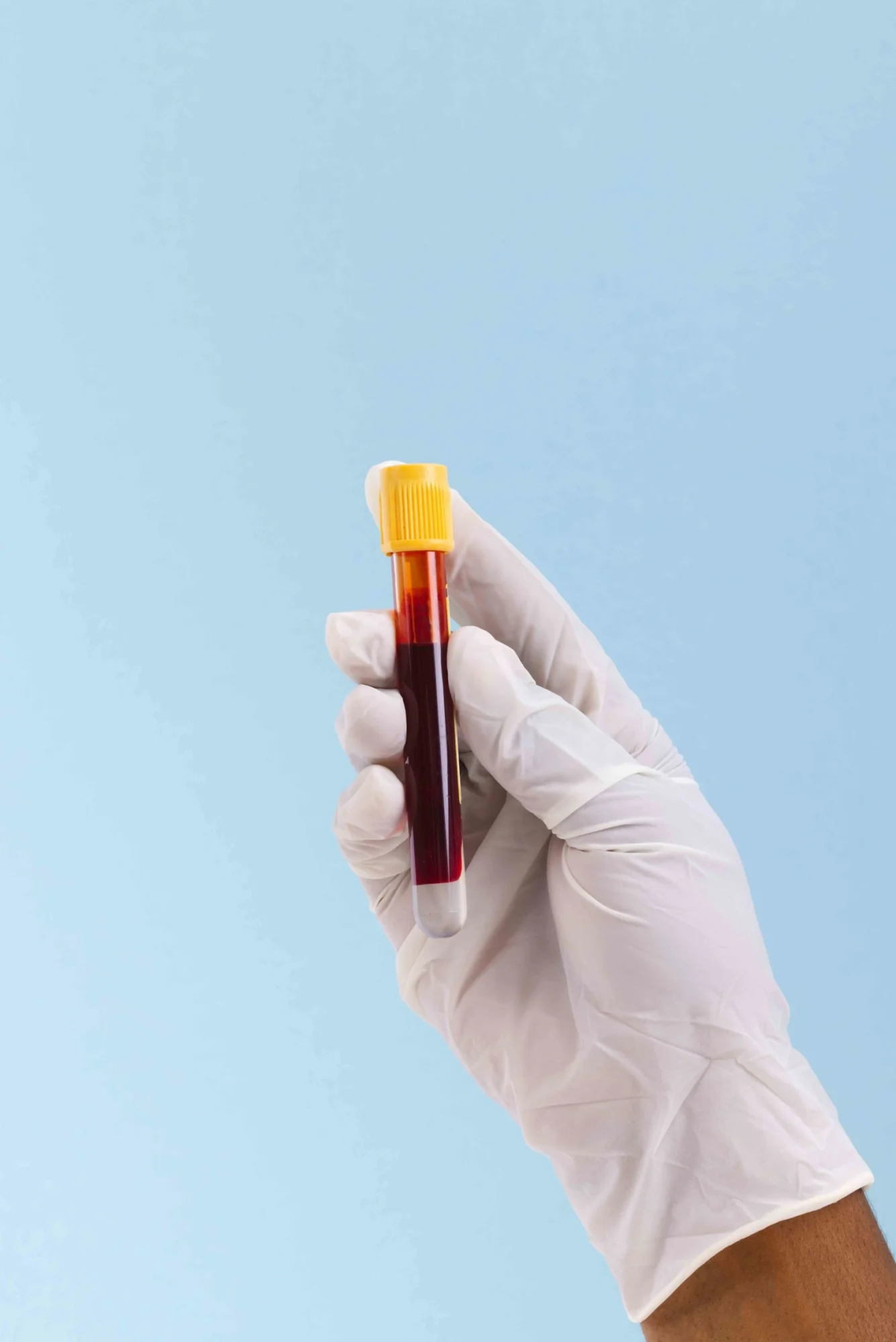 ประโยชน์ของการฉีดเกล็ดเลือด PRP – Platelet Rich Plasma