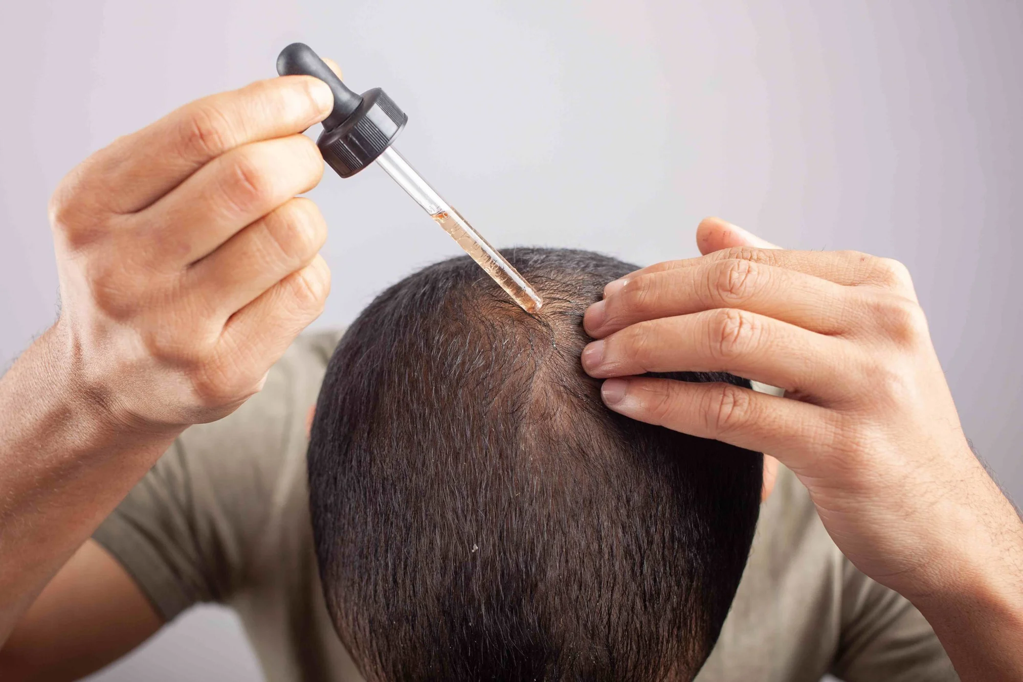 เรื่องที่ทุกคนควรรู้ก่อนใช้ ยาปลูกผม Minoxidil