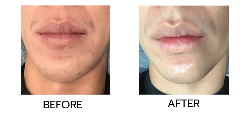 Review of beard and mustache hair removal. Results: Chin and beard look smoother and clearer.