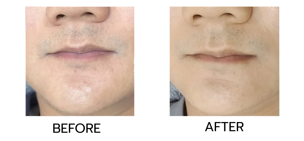 Review of beard and mustache hair removal. The results are that the hair disappears and does not grow back.