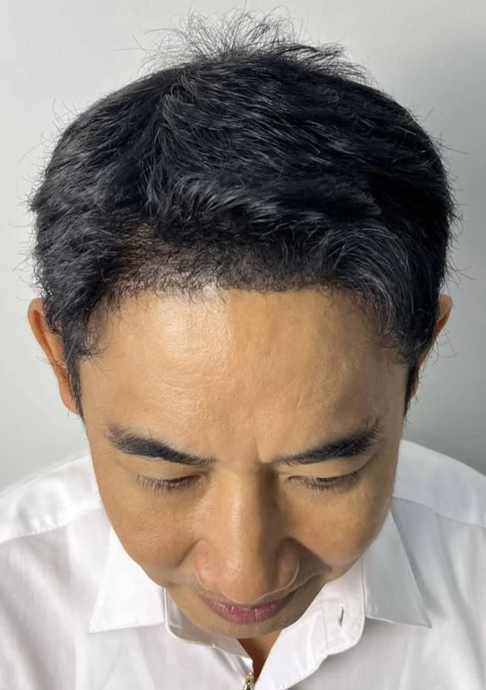 Review cases : 2nd round of hair transplantation, Thai customer, age 49