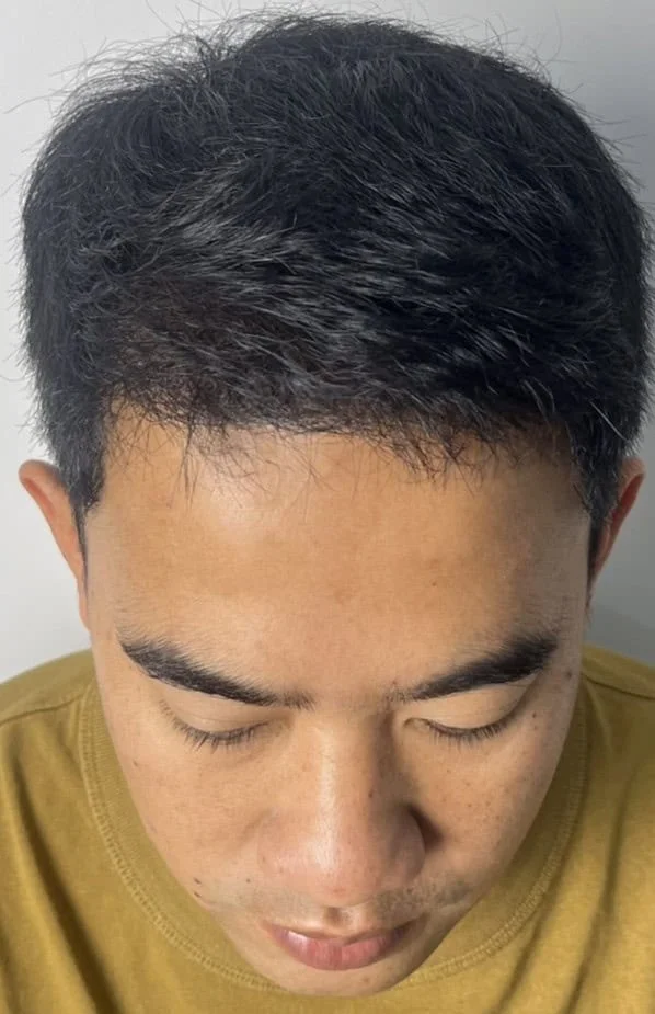 Review cases : Hair transplant round 2, Thai customer, age 33 years