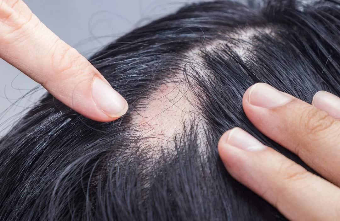 โรคผมร่วงเป็นหย่อม (Alopecia Areata): อาการ การวินิจฉัย และแนวทางการรักษาล่าสุด