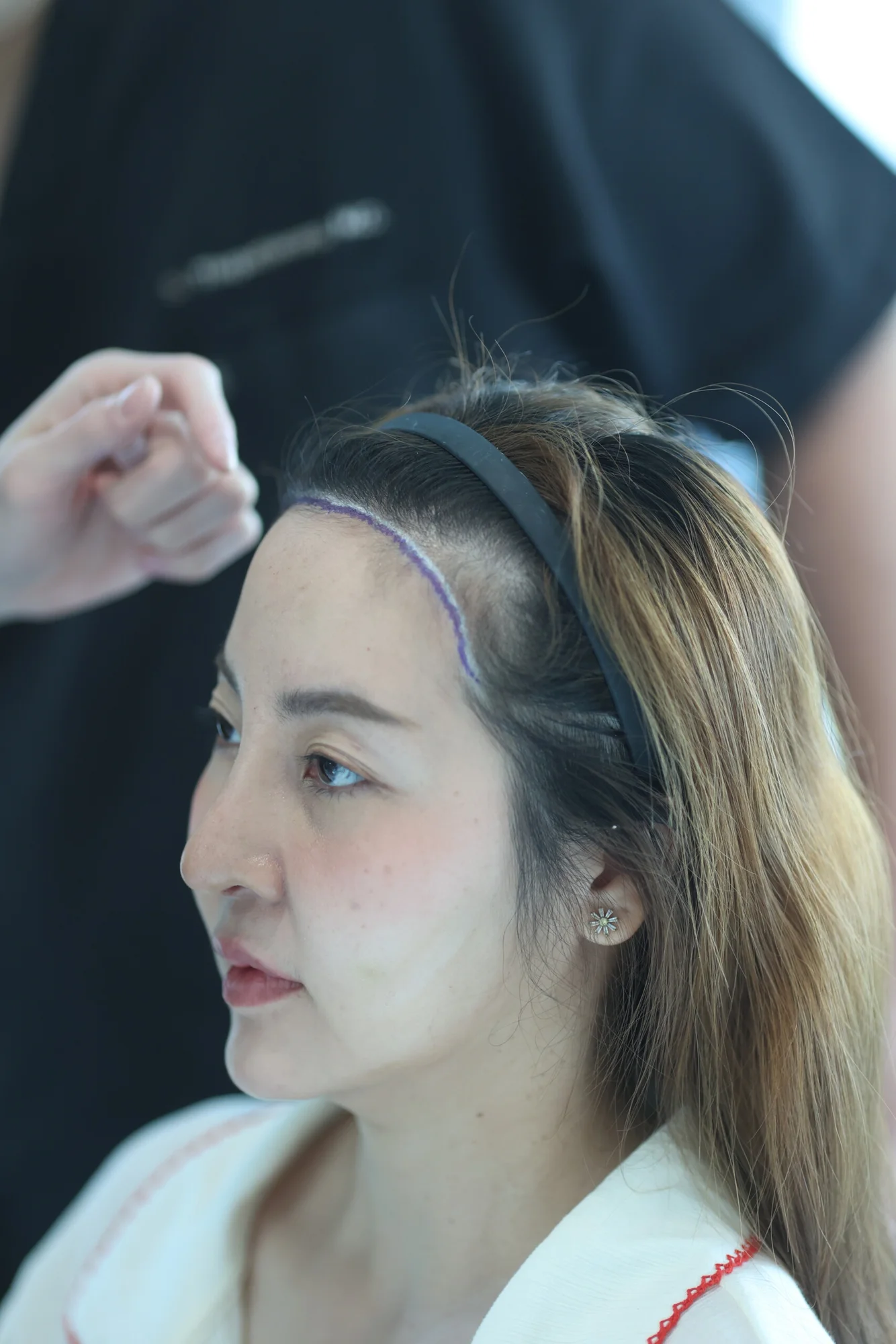 การปลูกผมปรับกรอบหน้าในผู้หญิงที่ MP Clinic