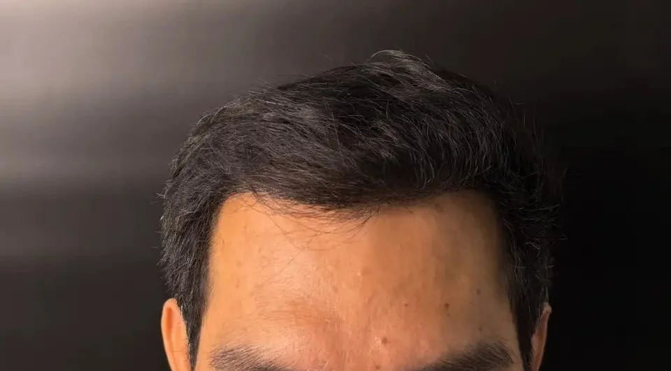 รีวิวเคสปลูกผมระดับรุนแรง (Advanced Hair Transplant) ระดับ 5