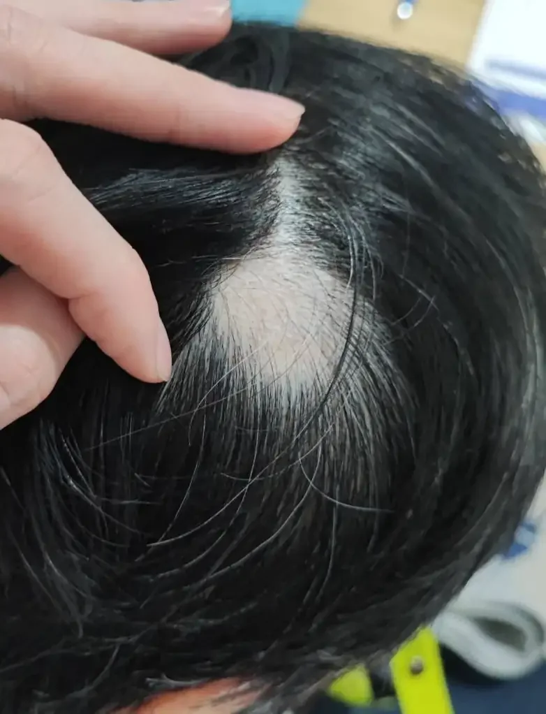 เคสรีวิว คุณ V ลูกค้าที่มีปัญหาผมร่วงเป็นหย่อม (Alopecia Areata) บริเวณหนังศีรษะ