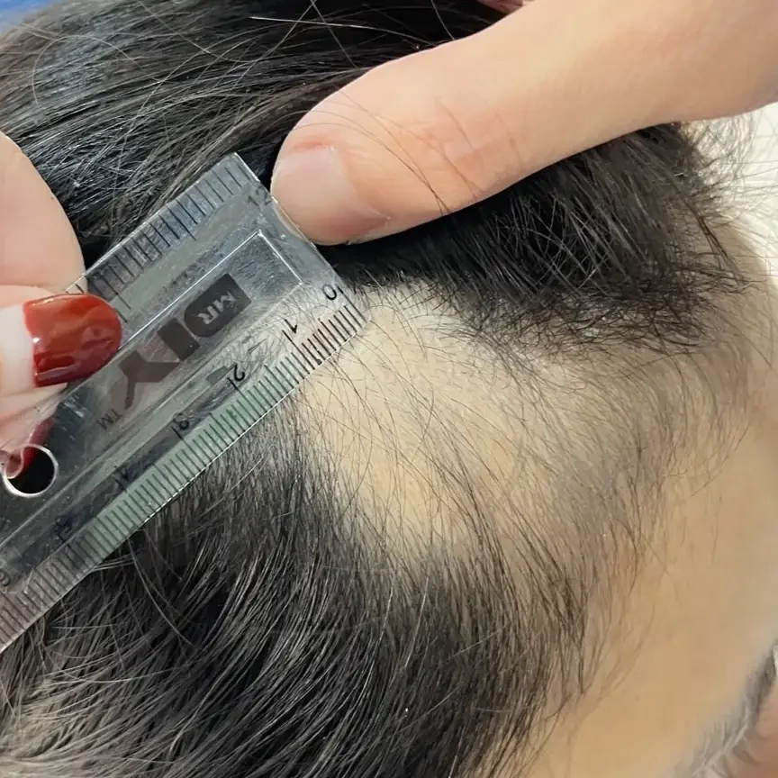เคสรีวิว คุณ J ลูกค้าที่มีปัญหาผมร่วงเป็นหย่อม (Alopecia Areata) บริเวณหนังศีรษะด้านหน้า