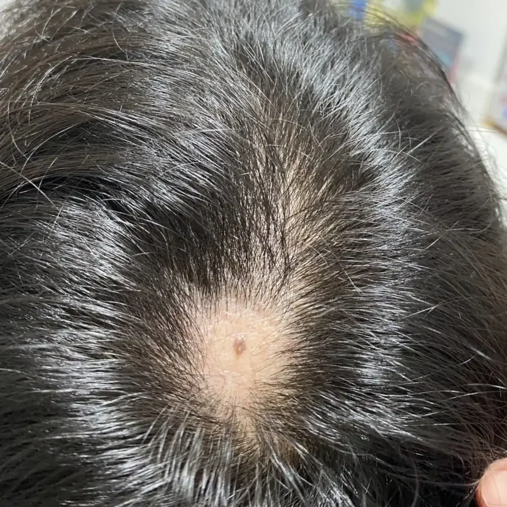 เคสรีวิว คุณ A ลูกค้าที่มีปัญหาผมร่วงเป็นหย่อม (Alopecia Areata) บริเวณหนังศีรษะด้านหน้า