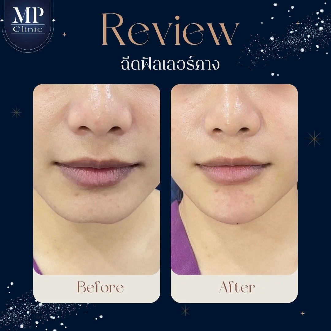 ปรับรูปหน้าด้วย Filler